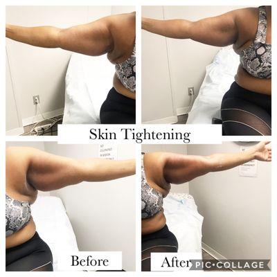 Skin Tightening & Cavitation