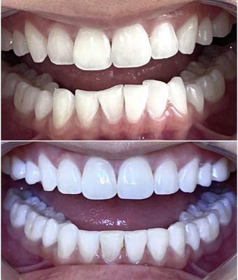 Only 3 months of clear aligners!