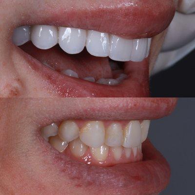 No prep veneers and bite corrections from TMJ pain
No shot
No drilling 
No pain
Patient flew in from Michigan 
Shade 1m1