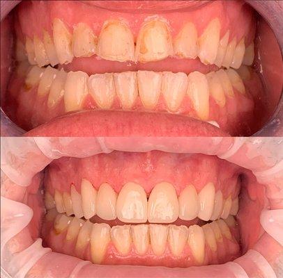 The Art of Dental Veneers: Before & After Marvel! Our patient had a lot of broken teeth and wanted Cosmetic Dentistry. He was super happy!