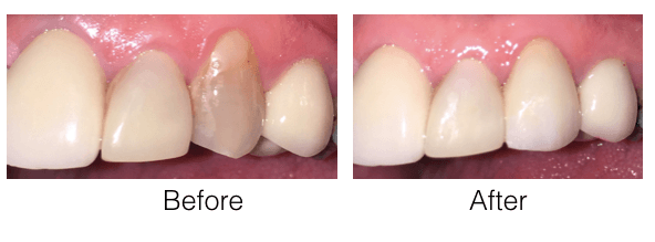 Cosmetic Dentistry - Before and After e.Max Dental Veneer