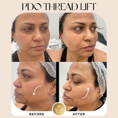 Non surgical face lift with PDO Threads