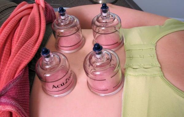 Cupping