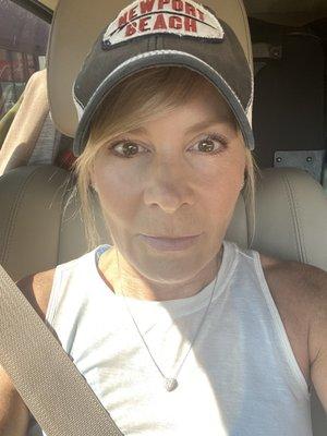 I'm 51 and have some dry skin/ lines around eyes and mouth. This is an unretouched photo after treatment.