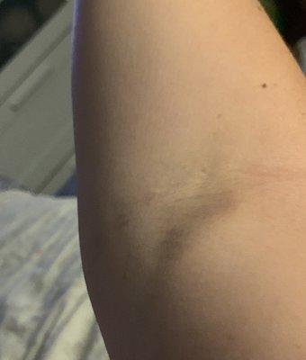 More bruising from attempt on different arm from drawing blood.