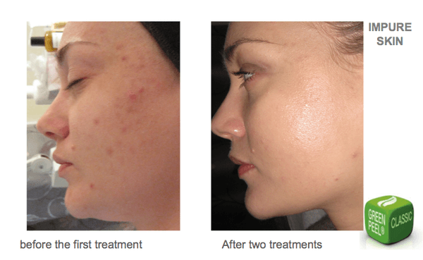 Performed by our certified esthetician in Green Peel, removes acne scars, wrinkles, blemishes, sun spots.