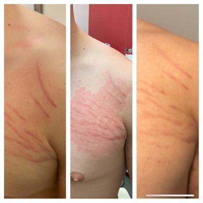 Stretch Mark Treatments!