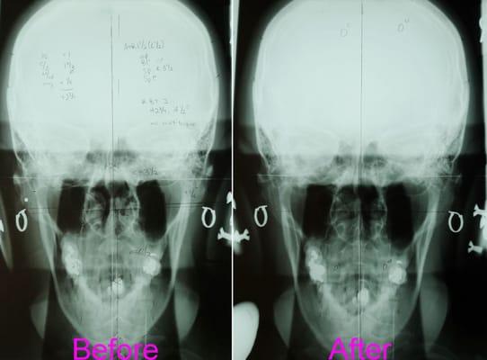 Before and after x-ray images