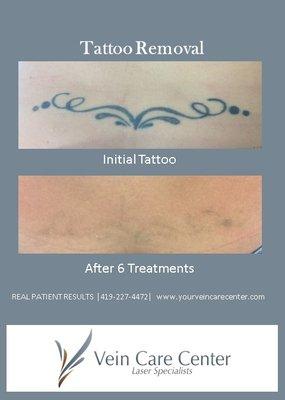 Laser tattoo removal results.