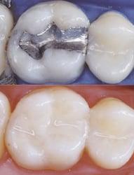 Ask us how we can replace your mercury containing fillings.