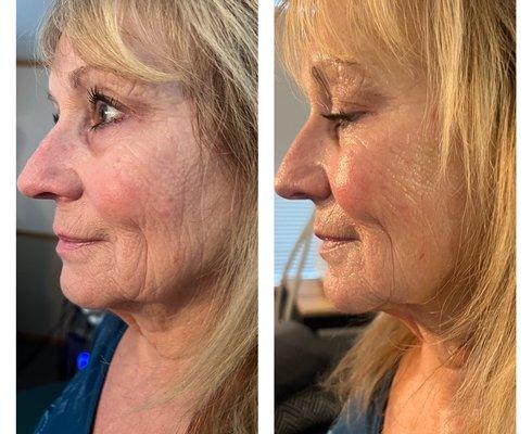 Our facelift treatments using R/F are so amazing . This was after 2 treatments (neck, chin , face )