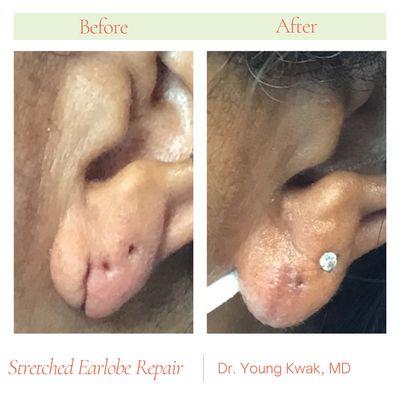 Stretched Earlobe Repair by Dr. Young Kwak