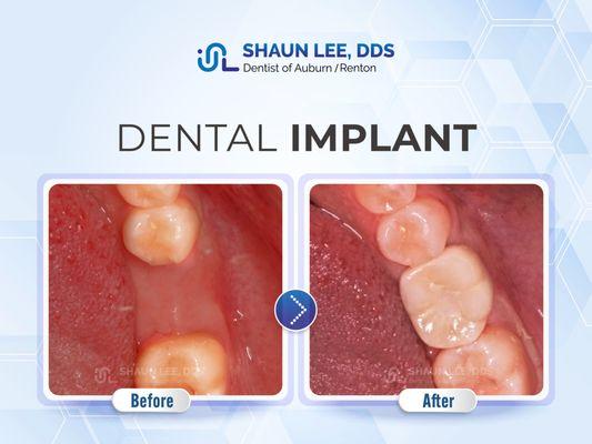 Shaun Lee, DDS Family Emergency Dental Implants of Renton | 10700 SE 174th Street, Suite 204, Renton, WA