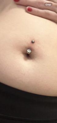 Mispierced and infected belly button piercing