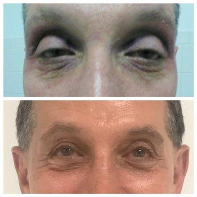 correction grade v upper eyelid ptosis with reconnection of muscle to tarsus