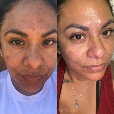 Virtual consultation client, 3 month progress!