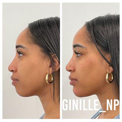 Cheeks and chin filler