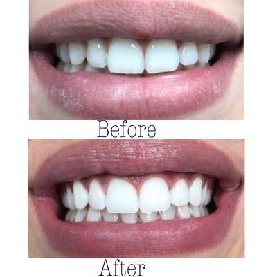 Zoom Whitening