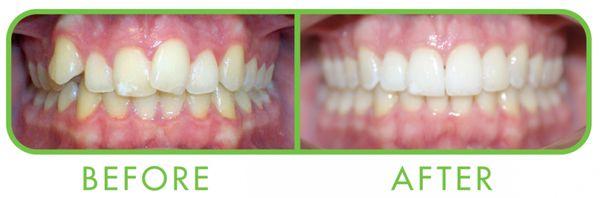 ClearCorrect invisible braces