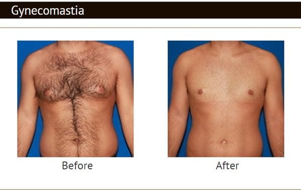 Gynecomastia surgery with minimal scarring