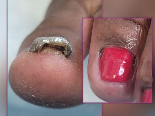 Medical Pedicure with toenail restoration