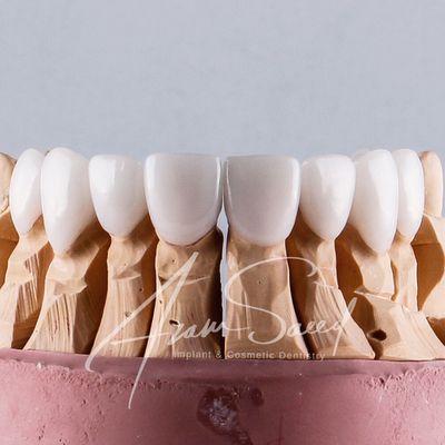 Beautiful porcelain veneers