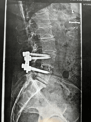 Screws and small pins to straighten my spine and give my nerve space. So greatful for Oregon Spine Care, I can ride my bike and run again.