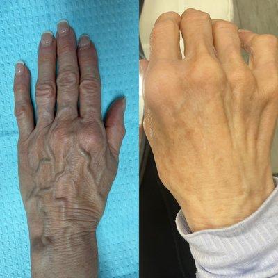 Before & After Radiesse in the hands. The after is taken 1 year after injections and this is all from collagen stimulation.