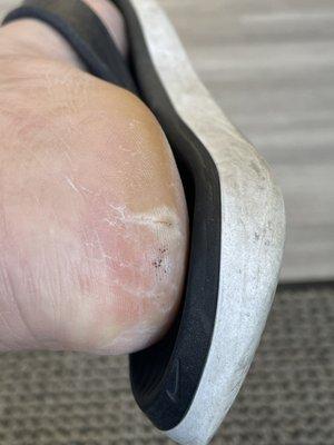 Other heel after pedicure