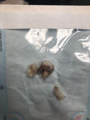 Broken file tip left in root canal sticking out of tooth #15