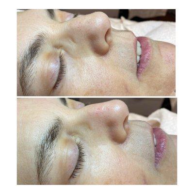 Oxygen facials by Tracy