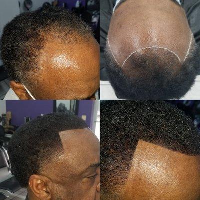 Restored hairline using hair fibers.