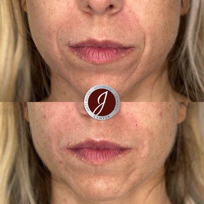 Nasolabial folds done with Juvederm