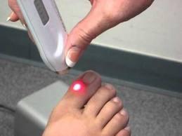 Laser treatment of toenail fungus