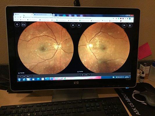 We can review the back of your eyes on the monitor when photos are taken with the retinal camera.