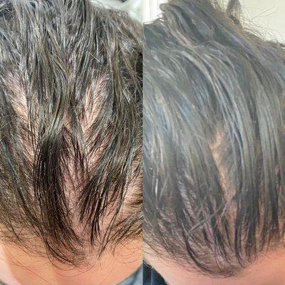 PRP hair restoration 6 months in after three treatments