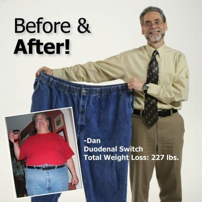 Dan lost 227 lbs. after having the Duodenal Switch with Dr. Srikanth.