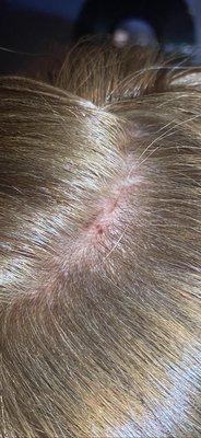 Scalp burns, told Lucy multiple times to stop yet continued.