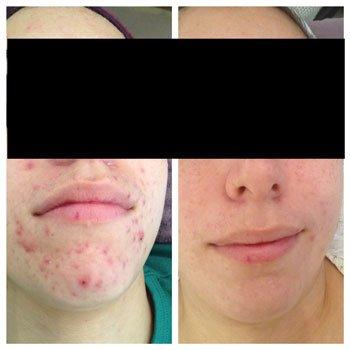 Client before/after acne treatments with microcurrent and Osmosis home care.