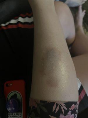 Bruises left by therapist