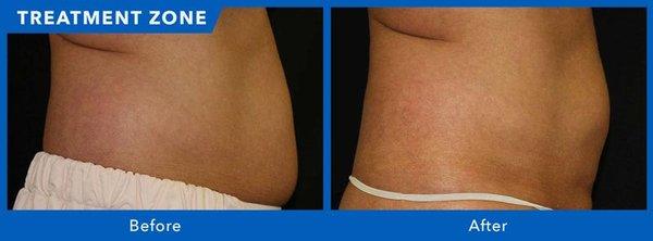 CoolSculpting Before & After at VIDA Aesthetic Medicine in Salem, OR