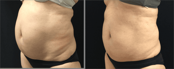 Tram Nguyen, MD's Patient C(ABDOMEN):Before and 8 weeks after first session