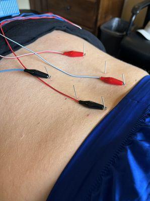 Dry needling can help with chronic lower back pain caused by spasm.