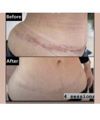 Tummy Tuck Scar Inkless Camouflage