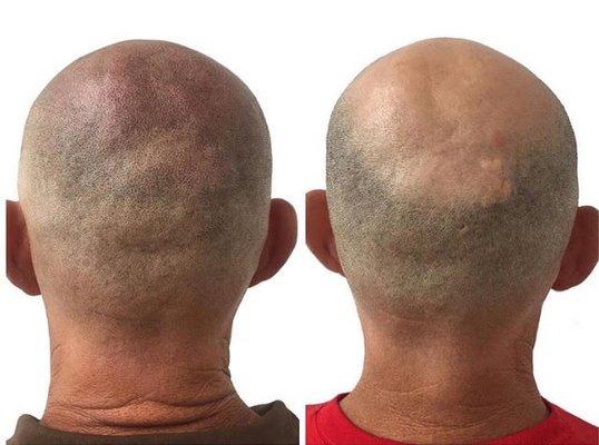 Let's restore the appearance of a full head of hair that is just barely shaved to the skin? You just need to book a visit!