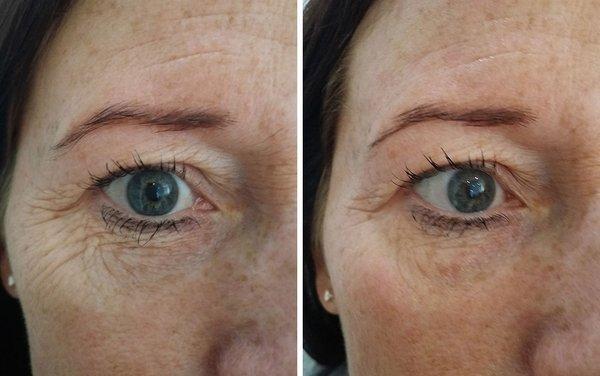 We offer skin tightening NOW! look at these results for yourself !