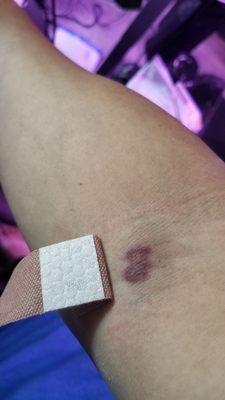 First time experiencing pain throughout when getting blood drawn. Bruised immediately.