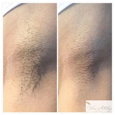 A four week before and after underarm wax