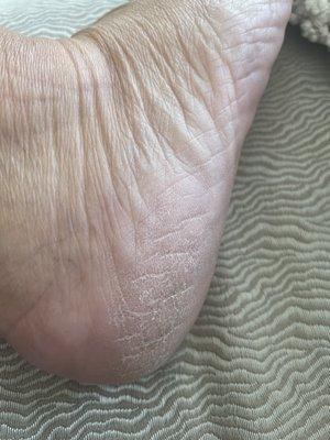 My heel the day after $85 pedicure with no massage or polish.