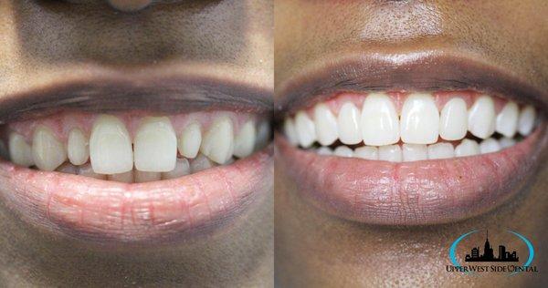 Veneers Before and After